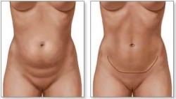 Todo sobre la abdominoplastia (cirugía de abdomen)