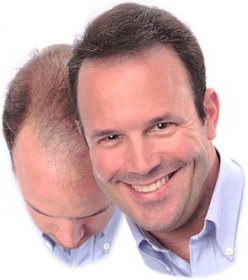 Todo sobre pérdida del cabello (caída del cabello)